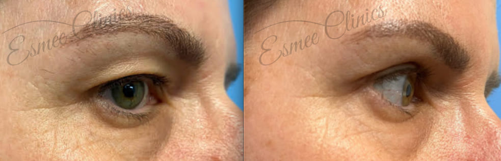 Before and After img